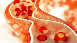 عدو القلب من الدرجة الأولى.. احذر هذه الأطعمة تسد شرايينك