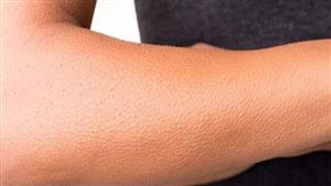 احذر.. علامة جلدية تنذرك بـ "قاتل صامت"  يجب ألا تتجاهلها أبدا