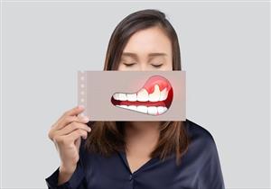 علاج التهاب اللثة بعسل النحل- 5 أنواع قد تساعدك