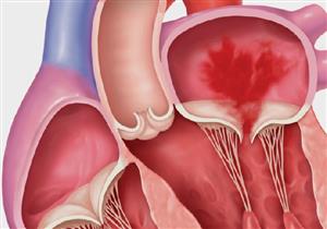 حسام موافي يحذر من ارتخاء الصمام: خطر في هذه الحالة