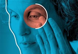 أعراض فرط نشاط الغدة الدرقية- 6 علامات تظهر في العين