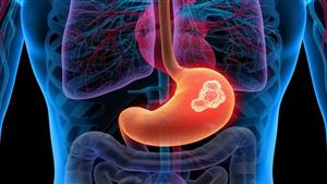 9 فئات عرضة للإصابة بسرطان المعدة أكثر من غيرهم 