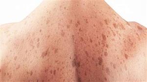 هذه الفئات الأكثر عرضة للإصابة بسرطان الجلد المميت