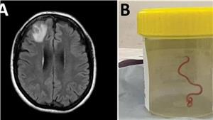 لأول مرة.. استخراج كائن حي من دماغ امرأة كانت تعاني من هذه الأعراض