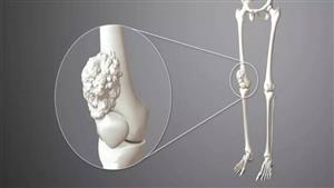 منها "ألم الركبة".. علامات قد تدل على الإصابة بسرطان العظام 