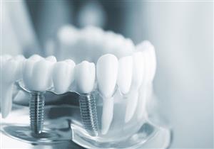 زراعة أسنان تسببت في إنهاء حياة رجل.. فما القصة؟