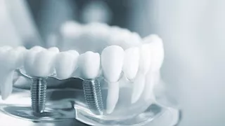 زراعة الأسنان.. هل تسبب الألم أو تتعرض للتسوس؟ (فيديو)