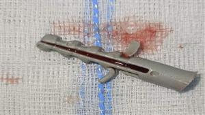 "فيشر مسمار" داخل الشعب الهوائية لطفل في قنا.. ماذا حدث له؟