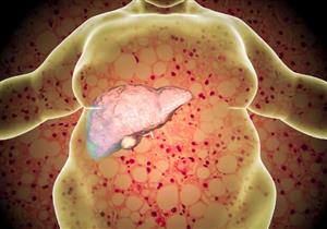 تظهر في الفم.. 5 أعراض تحذيرية تكشف إصابتك بمرض الكبد