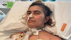 بعد تناول نوع صلصة.. إصابة سيدة بمرض نادر غيّر حياتها