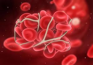  3 علامات تحذيرية تدل على وجود جلطة دموية