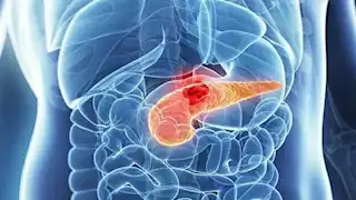 6 أعراض تنذر بوجود مشكلة في البنكرياس- لا تتجاهلها 