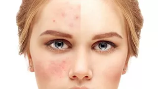 لماذا تظهر حبوب حمراء باستمرار في الوجه؟ 