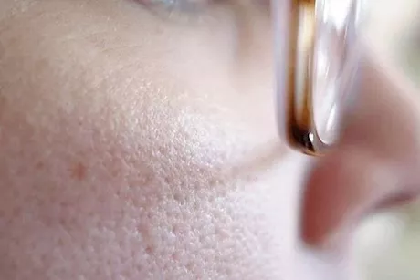 « الشوفان» أبرزها.. وداعًا للمسام الواسعة بهذه العلاجات المنزلية