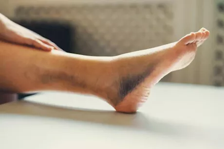 8 طرق لإذابة جلطة الساق- هل تكون فعالة؟ 