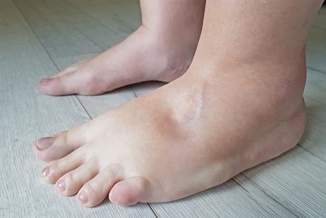 احرص على تناول هذه الأطعمة - تحميك من تورم القدمين 