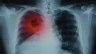 دراسة حديثة تفسر السبب وراء الانتشار السريع لسرطان الرئة صغير الخلايا