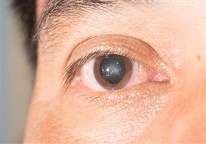 لا تصيب كبار السن فقط- دليل شامل عن المياه البيضاء للشباب