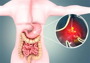 طبيب: تناول هذا الزيت على الريق يقي من قرحة المعدة "فيديو"