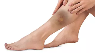 احذر.. الكدمات الغامضة في جسمك علامة على مشكلة صحية خطيرة