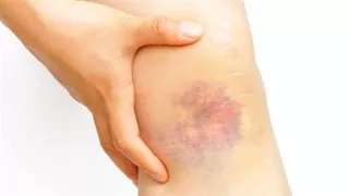 الكدمات المفاجئة على الجسم.. متى تصبح علامة مقلقة؟