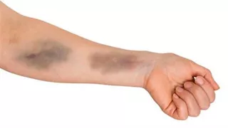   الكدمات المفاجئة.. متى تكون علامة على مشكلة صحية خطيرة؟