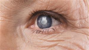 مرض "المياه الزرقاء".. هل يسبب العمى؟