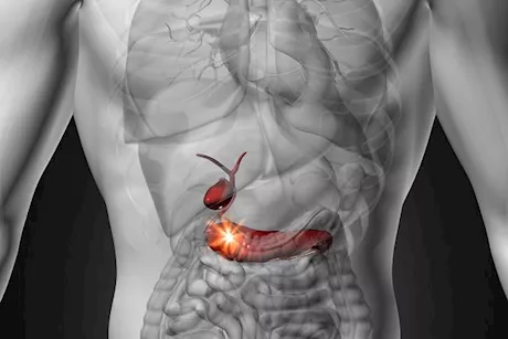 التهاب البنكرياس.. إليك الأسباب والأعراض