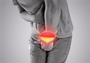 "اجري على دكتور المسالك"- حسام موافي يحذر الرجال من التبول المؤلم