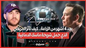 بعد 4 أشهر من الزراعة.. كيف تأثر المريض الذي حمل شريحة ماسك الدماغية