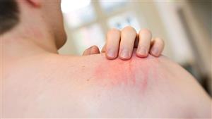 "الحساسية لسم الحشرات".. الأعراض والعلاج