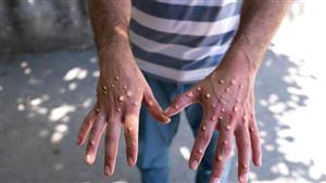 10 تعليمات مهمة.. ننشر دليل "الصحة" الإرشادي للتعامل مع جدري القردة (التشخيص والعلاج)