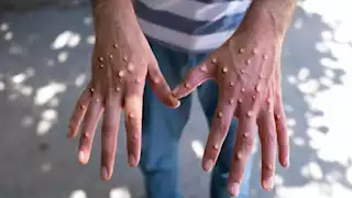 بينهم 66 حالة وفاة.. تسجيل 14700 حالة إصابة بجدري القردة في إفريقيا