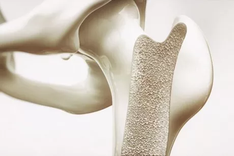 احذر- أعراض مبكرة تكشف إصابتك بهشاشة العظام