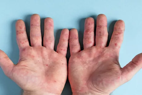 بعد إغلاق فصل بمدرسة دولية.. ما هو فيروس HFMD وأعراضه؟