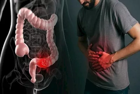 هل يمكن علاج الإمساك بتناول شاي البصل المجفف؟