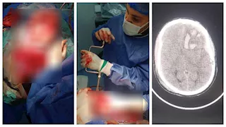 فريق طبي بمستشفى السنبلاوين العام ينقذ حياة مريض مصاب بنزيف حاد فى المخ