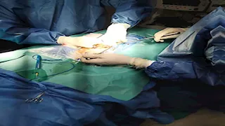 جراحة دقيقة ببني سويف.. استئصال ورم وزنه 15 كيلوجرامًا من ستينية