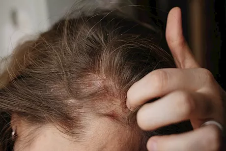  تينيا الشعر والثعلبة.. احذر الفرق بينهما