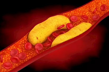 لعلاج الكوليسترول في 3 أشهر- تناول هذه الأطعمة
