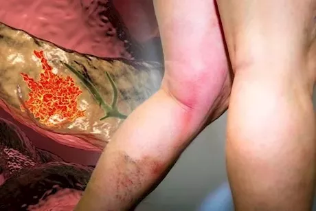 انتبه لساقيك- 4 أعراض لسرطان البنكرياس تظهر عليهما