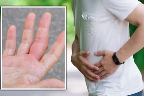 تظهر على اليدين- 6 أعراض لتليف الكبد احذرها