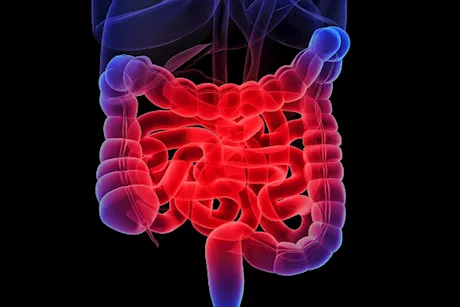 احذر- 6 علامات تخبرك بأن أمعاءك مصابة بالالتهاب