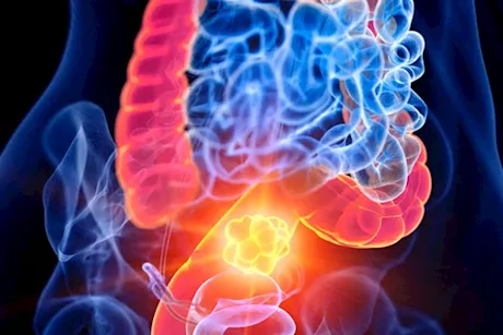 مضادات طبيعية للأورام- 4 فواكه تحميك من سرطان القولون