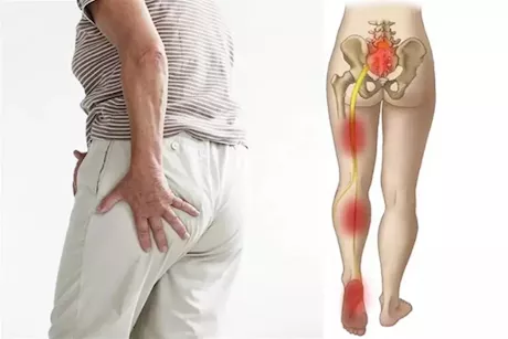 زيت الحلبة لعلاج عرق النسا- هل يحقق نتائج فعالة؟ 