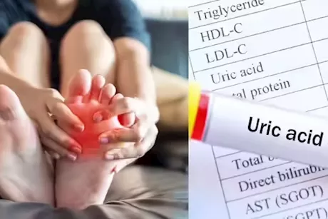 وداعًا لارتفاع حمض اليوريك- 5 فواكه تساعد على خفضه