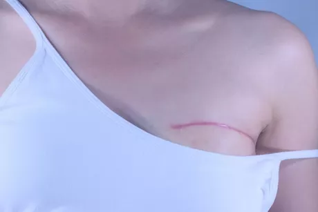 استئصال الثدي لعلاج السرطان- ماذا ينتظرِك بعد الجراحة؟ "فيديوجرافيك"