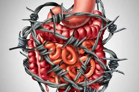 ليبراكس وكولونا- أيهما أفضل للقولون العصبي؟