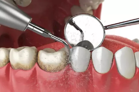 هل يلحق جلسة التنظيف الضرر بأسنانك؟