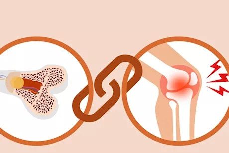 لمرضى هشاشة العظام- 6 مكملات غذائية لتخفيف ألم المفاصل